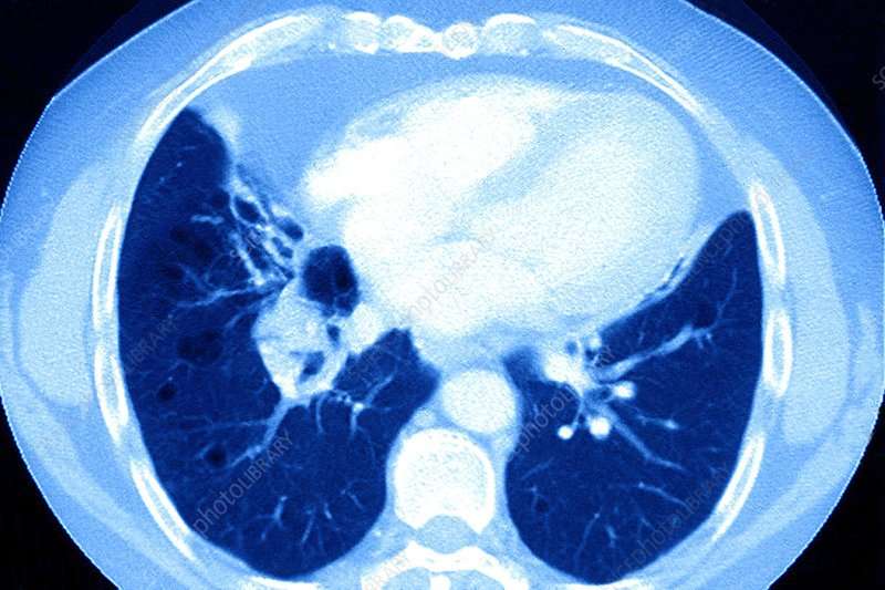 Lung cancer, ct scan