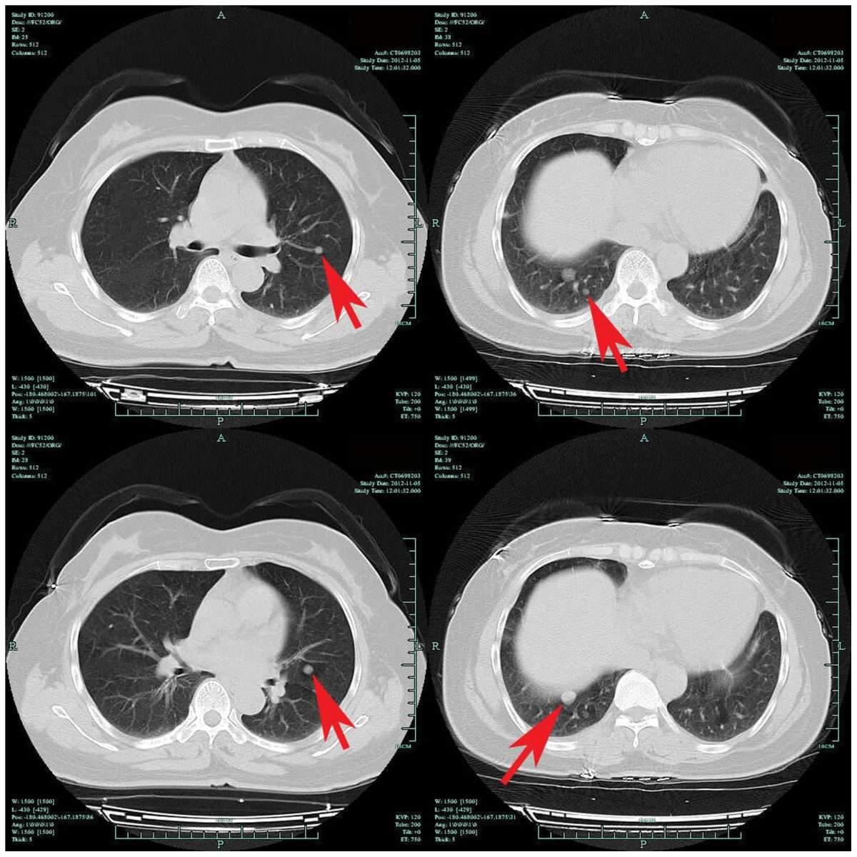 Ct Scan For Lung Nodule With Or Without Contrast